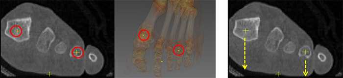 Figure 6. (Left) Centers of hallux and 4th toe. (Right) Refined position of hallux and 4th toe (the tips of the arrows).