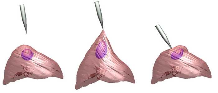 Figure 5. Deformation of the liver model consisting of heterogeneous tissues